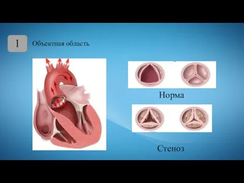 1 Норма Стеноз Объектная область