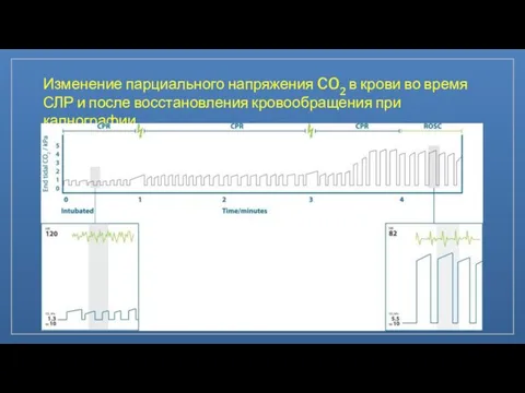 Изменение парциального напряжения CO2 в крови во время СЛР и после восстановления кровообращения при капнографии