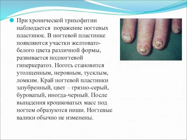 При хронической трихофитии наблюдается поражение ногтевых пластинок. В ногтевой пластинке появляются участки