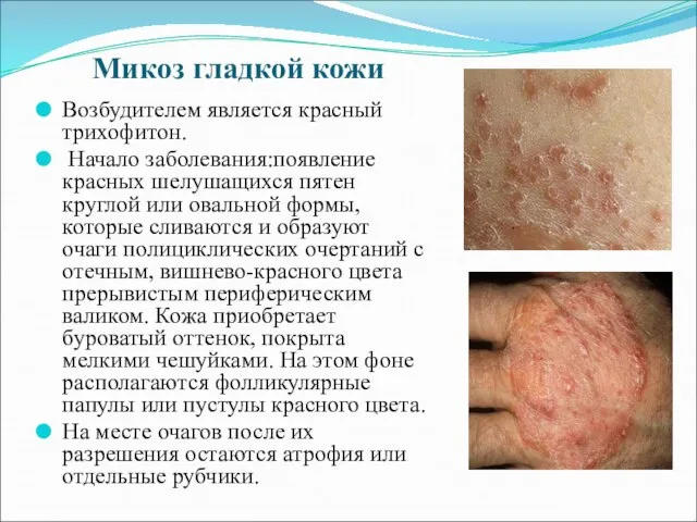 Микоз гладкой кожи Возбудителем является красный трихофитон. Начало заболевания:появление красных шелушащихся пятен