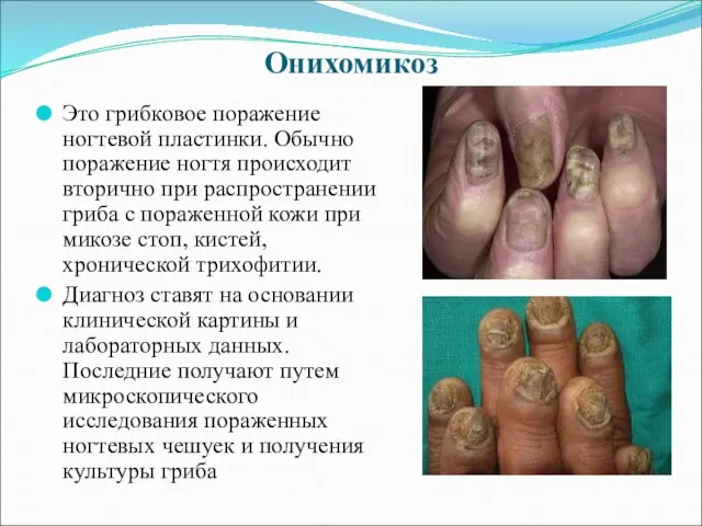 Онихомикоз Это грибковое поражение ногтевой пластинки. Обычно поражение ногтя происходит вторично при