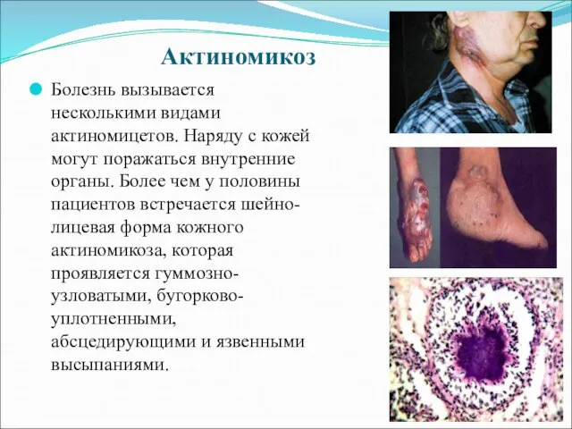 Актиномикоз Болезнь вызывается несколькими видами актиномицетов. Наряду с кожей могут поражаться внутренние