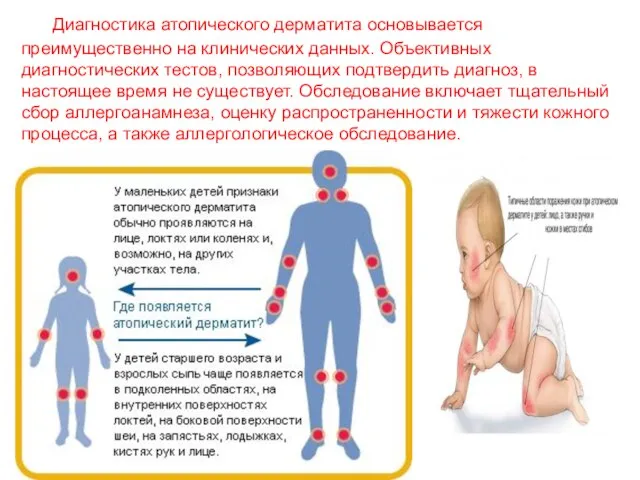 Диагностика атопического дерматита основывается преимущественно на клинических данных. Объективных диагностических тестов, позволяющих