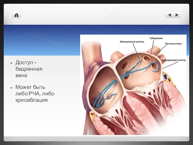Доступ – бедренная вена Может быть либо РЧА, либо криоаблация