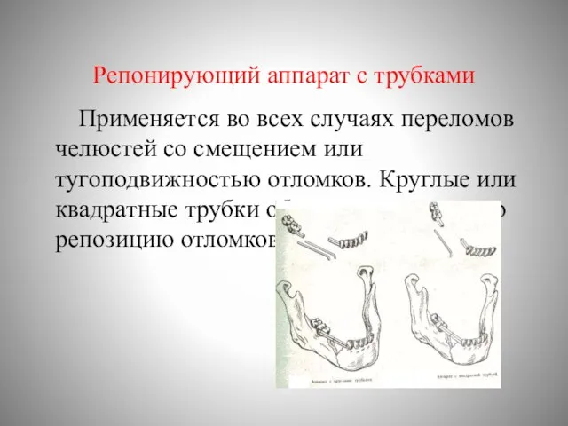 Репонирующий аппарат с трубками Применяется во всех случаях переломов челюстей со смещением