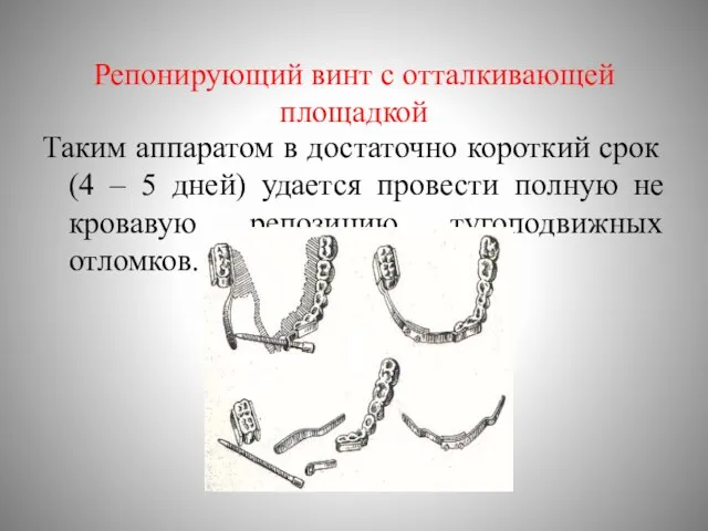 Репонирующий винт с отталкивающей площадкой Таким аппаратом в достаточно короткий срок (4