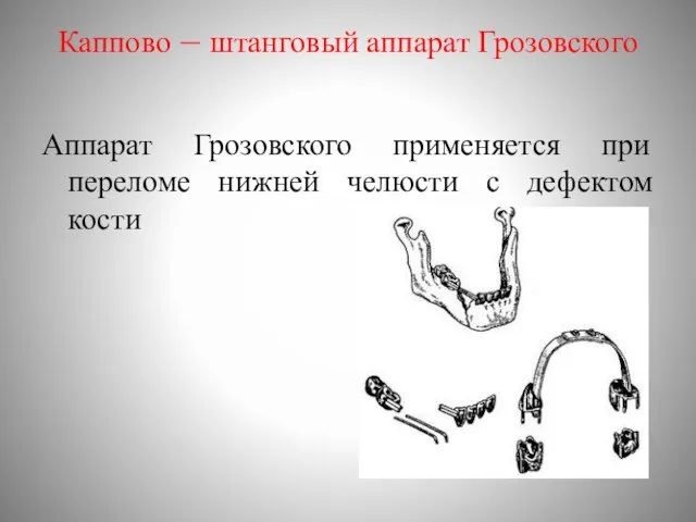 Каппово – штанговый аппарат Грозовского Аппарат Грозовского применяется при переломе нижней челюсти с дефектом кости