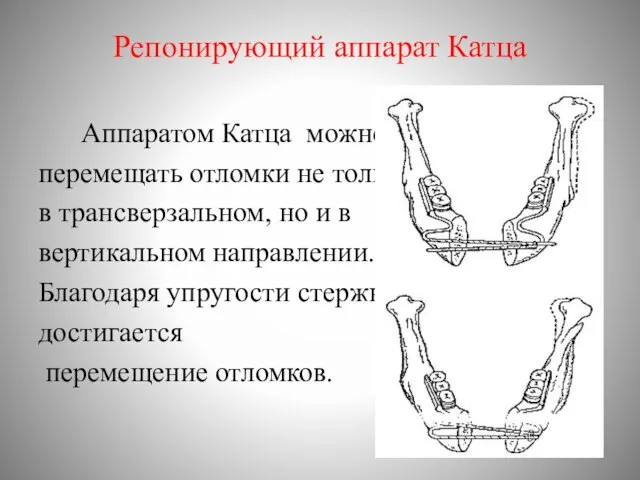 Репонирующий аппарат Катца Аппаратом Катца можно перемещать отломки не только в трансверзальном,