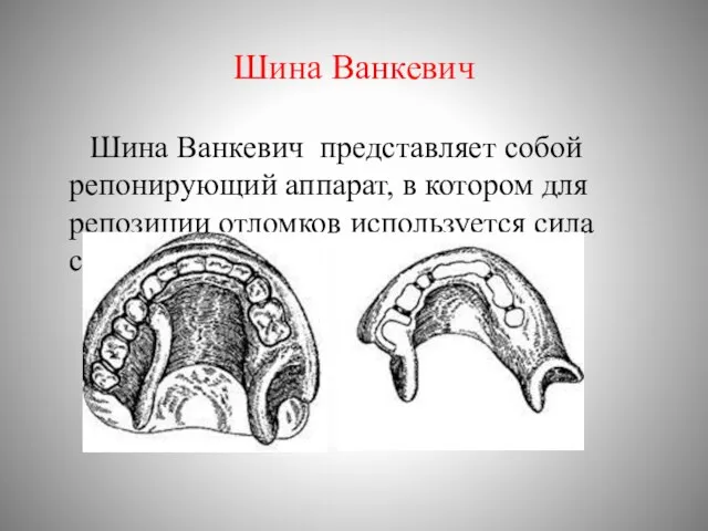 Шина Ванкевич Шина Ванкевич представляет собой репонирующий аппарат, в котором для репозиции