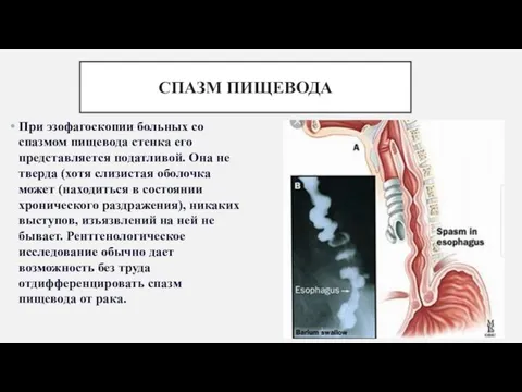 СПАЗМ ПИЩЕВОДА При эзофагоскопии больных со спазмом пищевода стенка его представляется податливой.