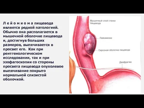 Л е й о м и о м а пищевода является редкой