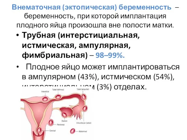 Внематочная (эктопическая) беременность – беременность, при которой имплантация плодного яйца произошла вне