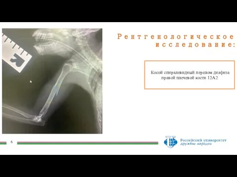 Рентгенологическое исследование: Косой спиралевидный перелом диафиза правой плечевой кости 12А2