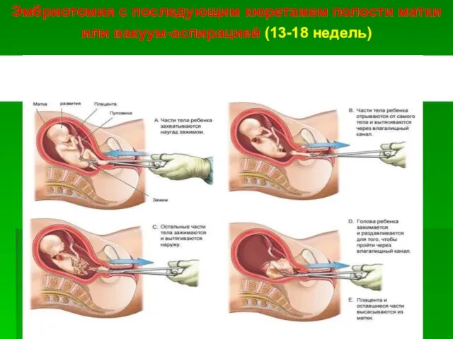 Эмбриотомия с последующим кюретажем полости матки или вакуум-аспирацией (13-18 недель)