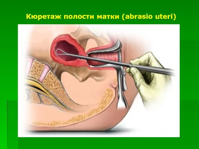 Кюретаж полости матки (abrasio uteri)