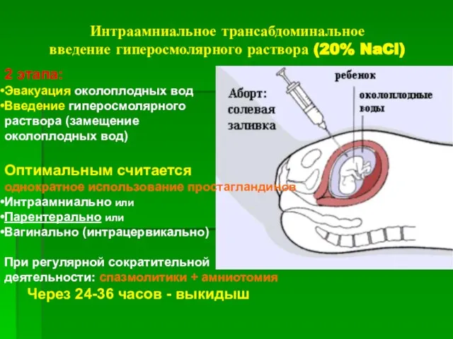 Интраамниальное трансабдоминальное введение гиперосмолярного раствора (20% NaCl) 2 этапа: Эвакуация околоплодных вод