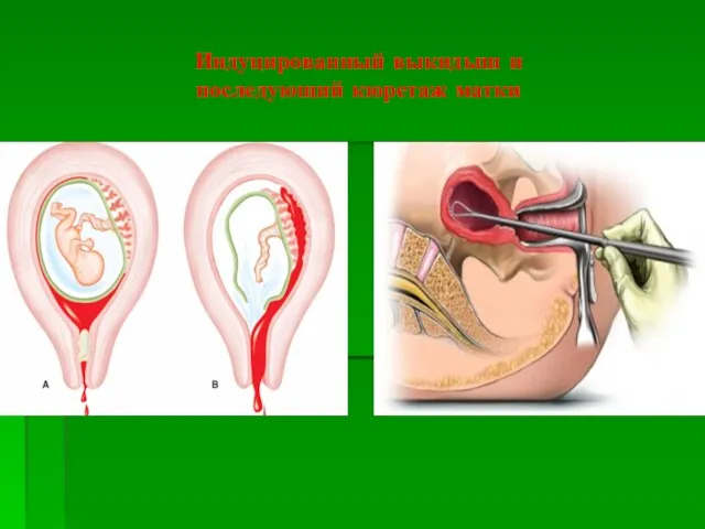 Индуцированный выкидыш и последующий кюретаж матки