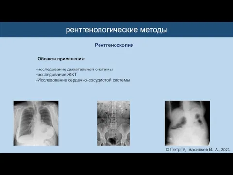 © ПетрГУ, Васильев В. А., 2021 рентгенологические методы Рентгеноскопия Области применения: исследование