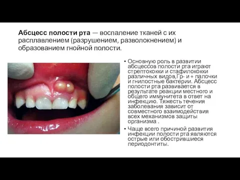 Абсцесс полости рта — воспаление тканей с их расплавлением (разрушением, разволокнением) и