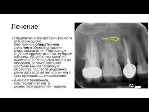 Лечение Пациентам с абсцессами полости рта необходимо неотложное оперативное лечение в объёме