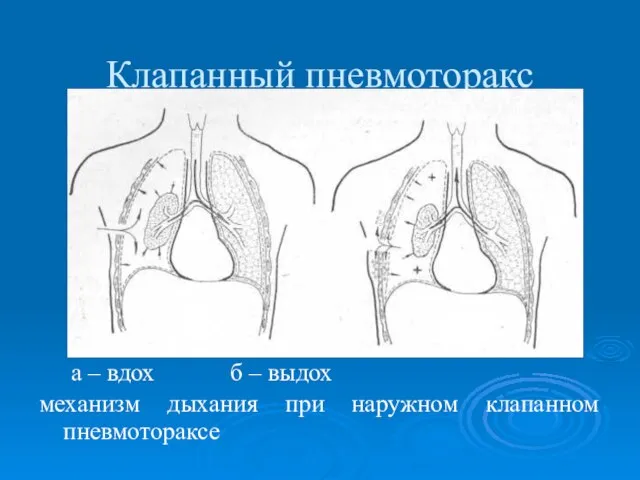 Клапанный пневмоторакс а – вдох б – выдох механизм дыхания при наружном клапанном пневмотораксе