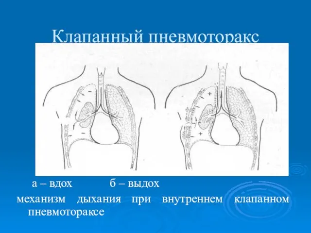 Клапанный пневмоторакс а – вдох б – выдох механизм дыхания при внутреннем клапанном пневмотораксе