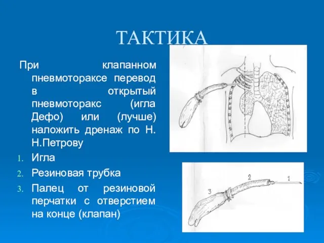 ТАКТИКА При клапанном пневмотораксе перевод в открытый пневмоторакс (игла Дефо) или (лучше)