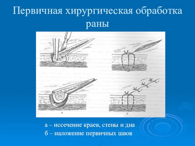 Первичная хирургическая обработка раны а – иссечение краев, стены и дна б – наложение первичных швов