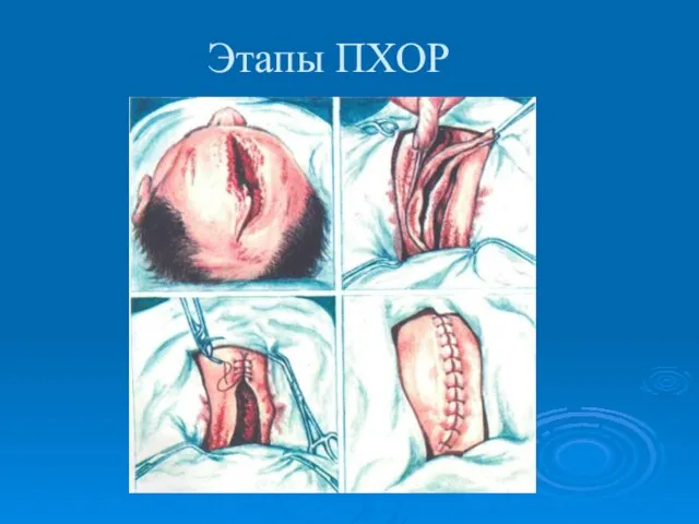 Этапы ПХОР