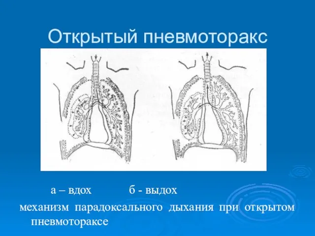 Открытый пневмоторакс а – вдох б - выдох механизм парадоксального дыхания при открытом пневмотораксе