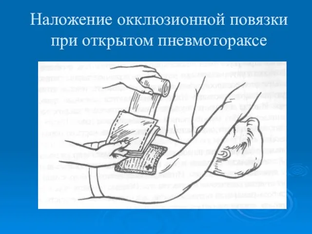 Наложение окклюзионной повязки при открытом пневмотораксе