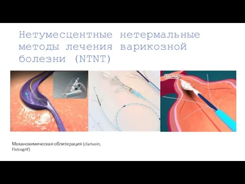 Нетумесцентные нетермальные методы лечения варикозной болезни (NTNT) Механохимическая облитерация (clarivein, Flebogrif)