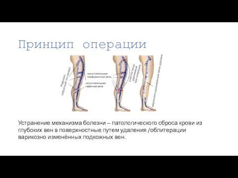 Принцип операции Устранение механизма болезни ‒ патологического сброса крови из глубоких вен