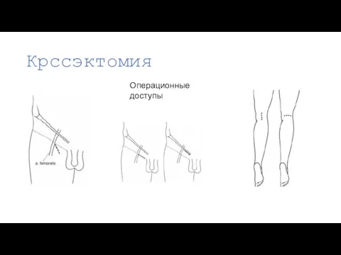 Крссэктомия Операционные доступы