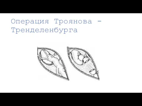 Операция Троянова - Тренделенбурга