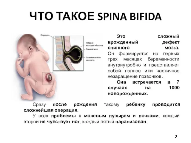ЧТО ТАКОЕ SPINA BIFIDA Это сложный врожденный дефект спинного мозга. Он формируется