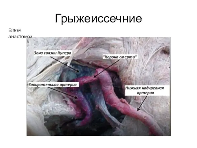 Грыжеиссечние В 30% анастомоз