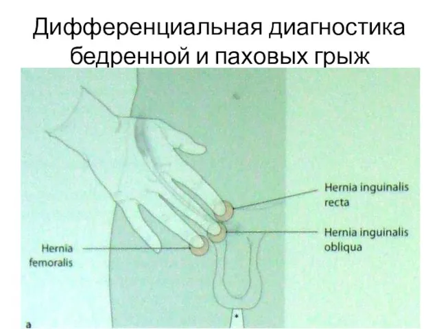 Дифференциальная диагностика бедренной и паховых грыж *