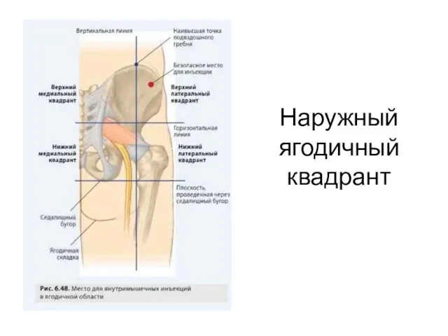 Наружный ягодичный квадрант