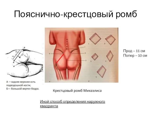 Пояснично-крестцовый ромб Прод – 11 см Попер – 10 см Иной способ определения наружного квадранта