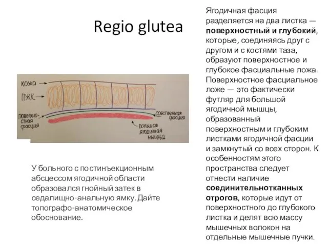 Regio glutea У больного с постинъекционным абсцессом ягодичной области образовался гнойный затек