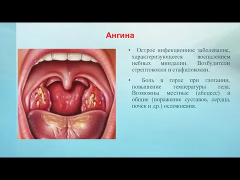 Ангина Острое инфекционное заболевание, характеризующееся воспалением небных миндалин. Возбудители стрептококки и стафилококки.