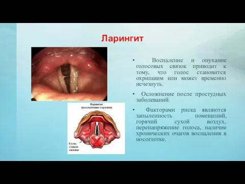 Ларингит Воспаление и опухание голосовых связок приводит к тому, что голос становится