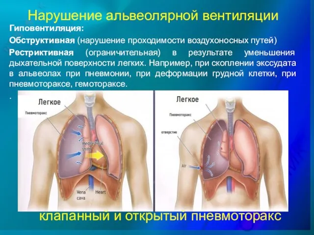 Нарушение альвеолярной вентиляции Гиповентиляция: Обструктивная (нарушение проходимости воздухоносных путей) Рестриктивная (ограничительная) в