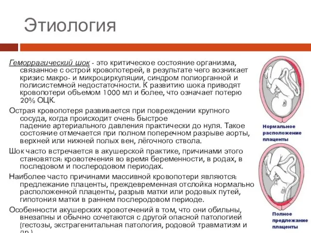 Этиология Геморрагический шок - это критическое состояние организма, связанное с острой кровопотерей,