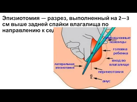 Эпизиотомия — разрез, выполненный на 2—3 см выше задней спайки влагалища по направлению к седалищному бугру.