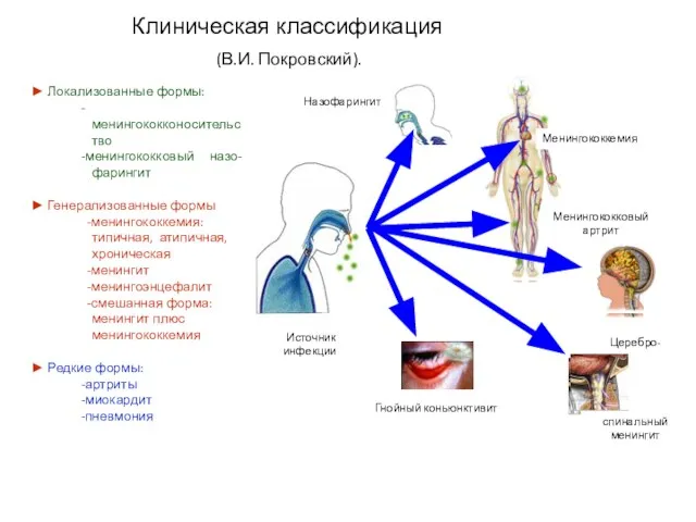 Назофарингит Церебро- спинальный менингит Менингококкемия Менингококковый артрит Источник инфекции Гнойный коньюнктивит ►