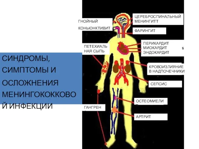 СИНДРОМЫ, СИМПТОМЫ И ОСЛОЖНЕНИЯ МЕНИНГОКОККОВОЙ ИНФЕКЦИИ