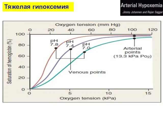 Тяжелая гипоксемия