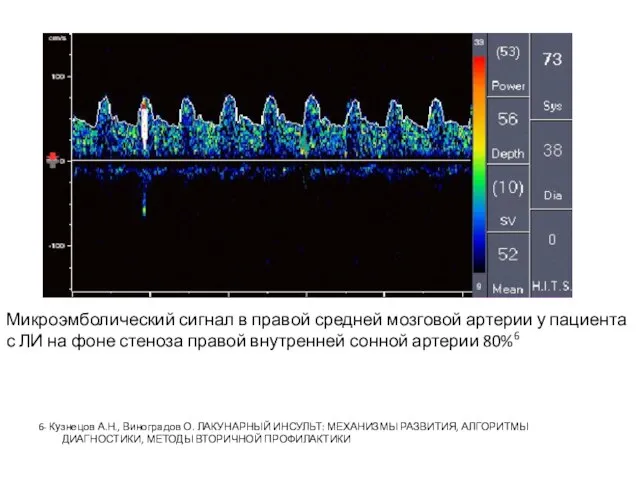 6- Кузнецов А.Н., Виноградов О. ЛАКУНАРНЫЙ ИНСУЛЬТ: МЕХАНИЗМЫ РАЗВИТИЯ, АЛГОРИТМЫ ДИАГНОСТИКИ, МЕТОДЫ